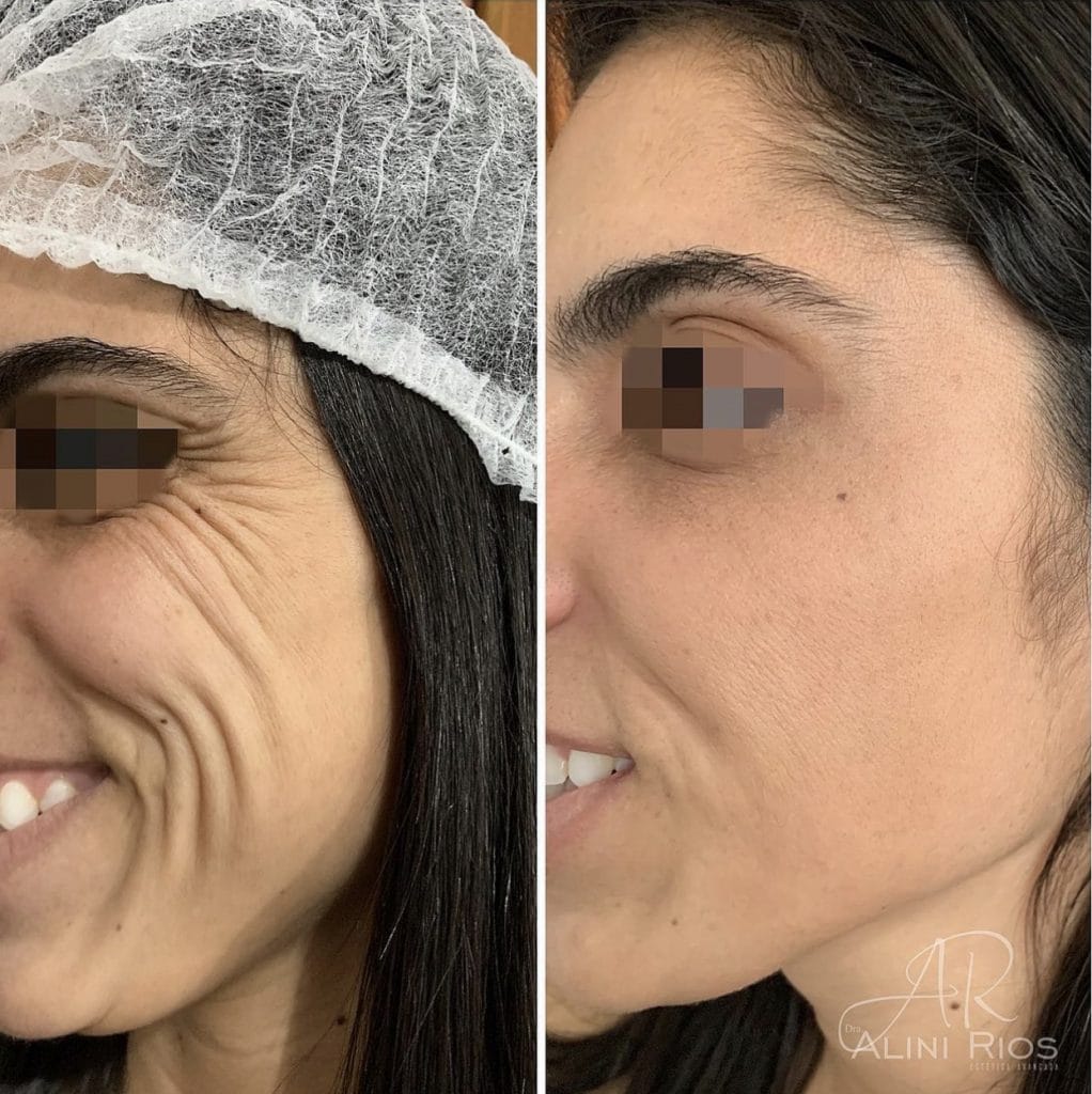 Curso de Toxina Bt V2 11 IMG_1154